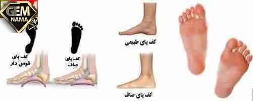 تحقیق درباره صافی کف پا