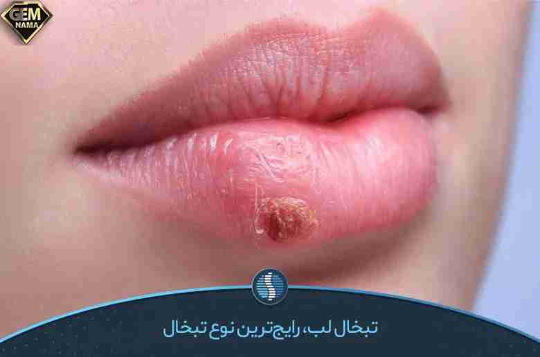 برای تبخال لب چی خوبه