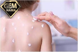 برای آبله مرغان چی خوبه