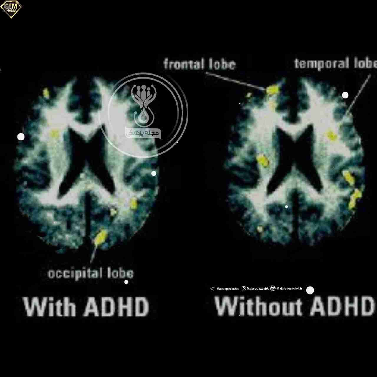 مقایسه مغز فرد نرمال با فردی که adhd دارد