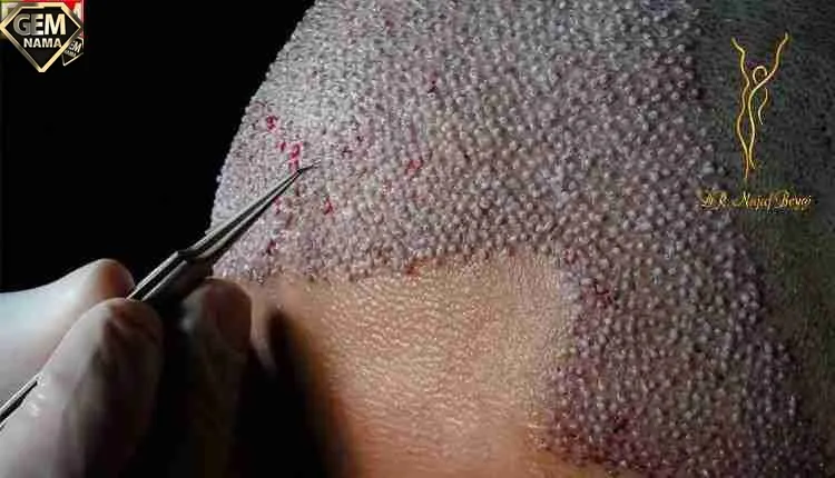 یک جراح کاشت مو مناسب چه ویژگی هایی باید داشته باشد