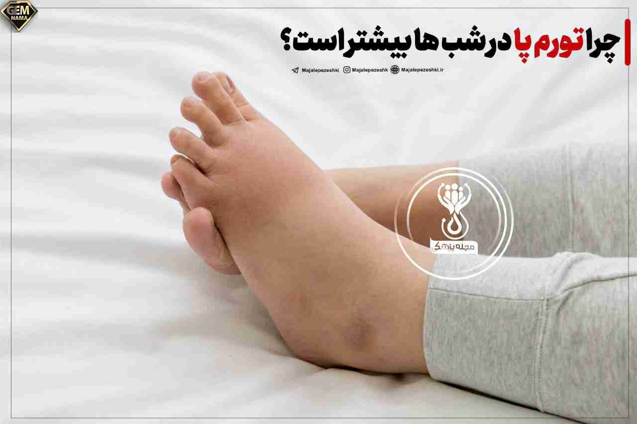 چرا تورم پا در شب ها بیشتر است
