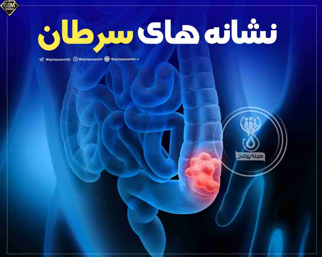 نشانههای سرطان روده بزرگ که نباید نادیده بگیرید