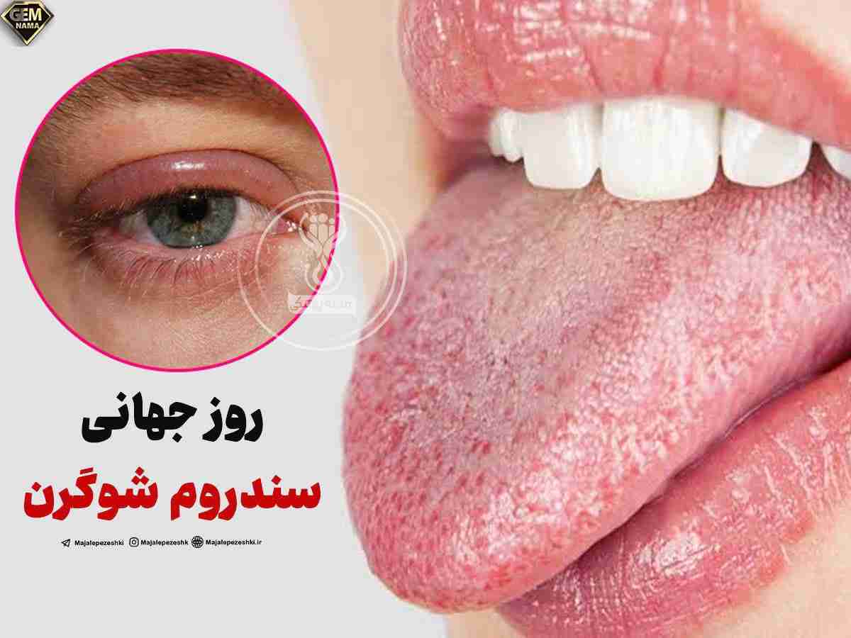 سندروم شوگرن چیست و تا چه حد خطرناک است