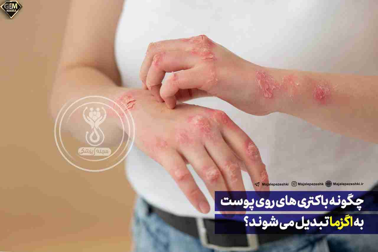 چگونه باکتری های روی پوست به اگزما تبدیل می شوند