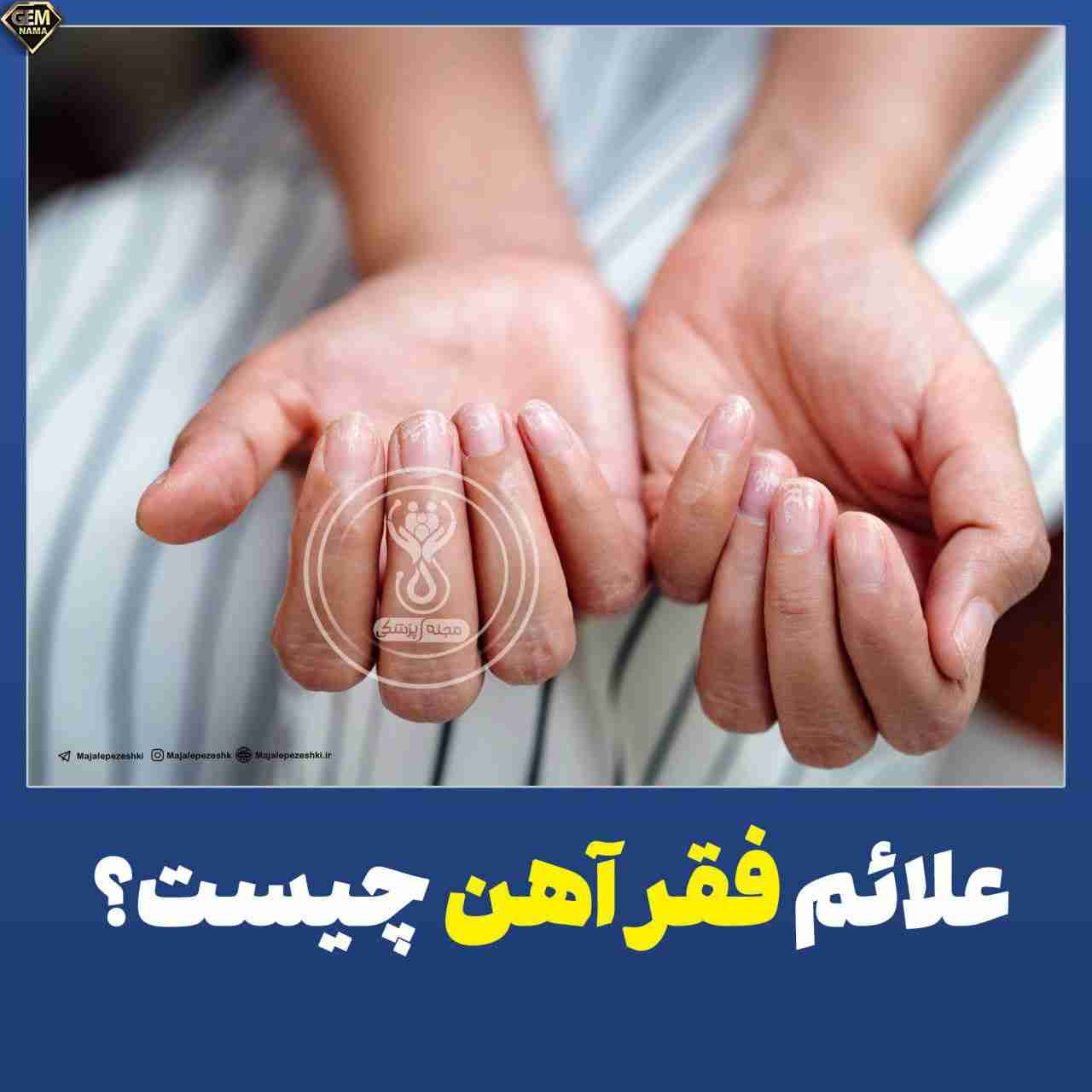 علائم فقر آهن چیست