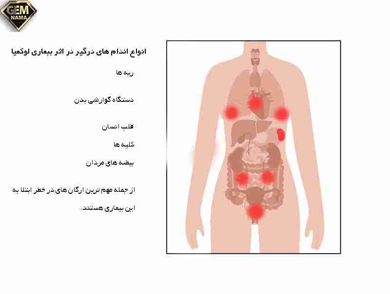 علائم شایع سرطان خون