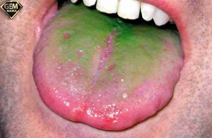 پرز زبان سیگاری ها بعد از سالها سبز میشود