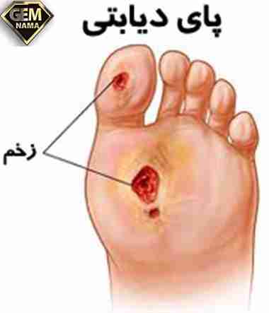 مرگ بافت های بدن قانقاریا