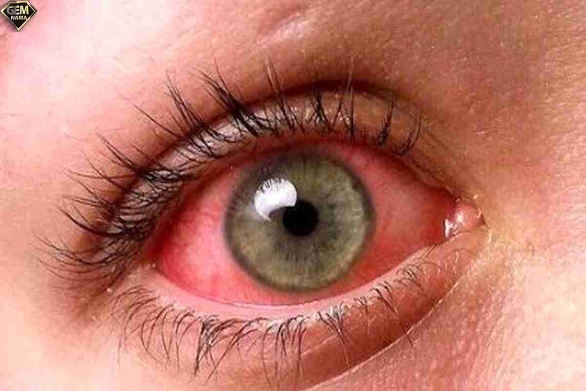 تشخیص آلزایمر از روی چشم ممکن شد