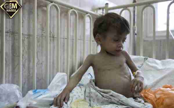 ۵۷ درصد از جمعیت ایران سوءتغذیه دارند و کالری لازم را دریافت