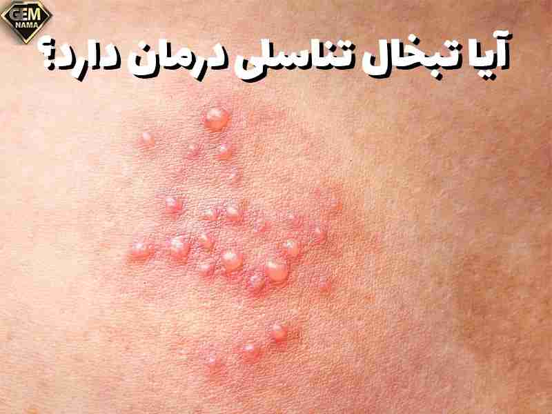 از کجا بفهمیم تبخال تناسلی داریم