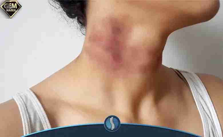چگونه کبودی گردن را از بین ببریم