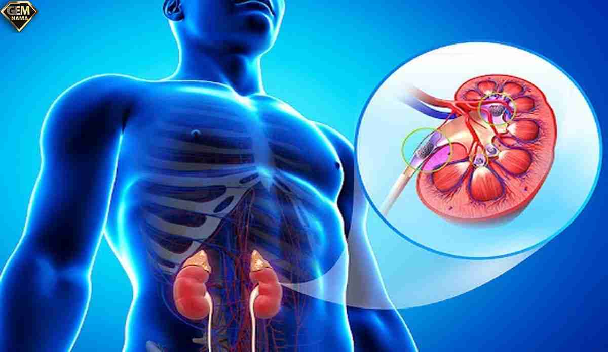 بهترین معجون برای دفع سنگ کلیه