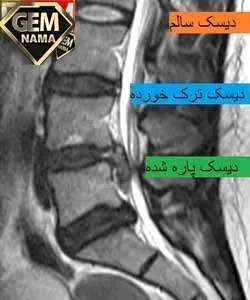 منشا درد سیاتیک